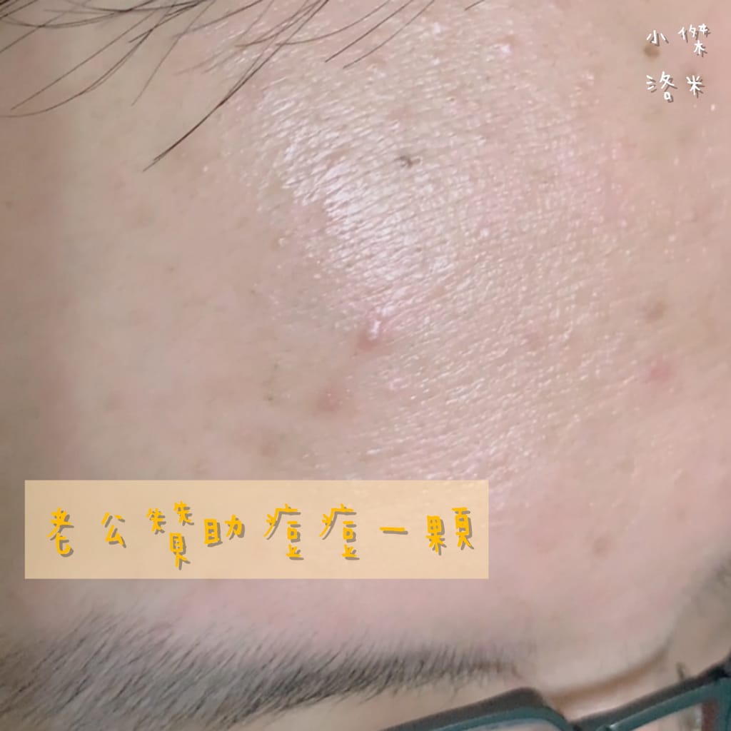 《美容》水楊酸戰痘局部修護精華 ｜痘痘救星 神奇藍點滴 肌羽顏SKIN LANGUAGE 替肌膚開口說話