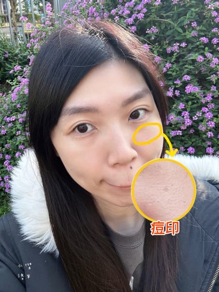 《保養》二訪愛爾麗診所｜台北蜂巢皮秒心得分享 調理毛孔與斑點